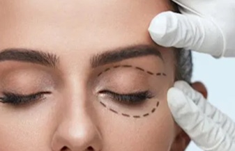 Browlift para elevação das sobrancelhas