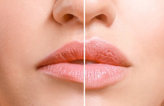 Lipflift para elevação dos lábios