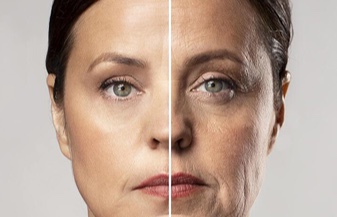 Minilifting facial