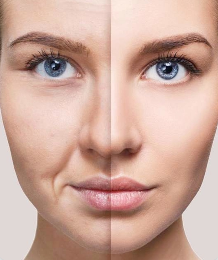 Preenchimento facial com ácido hialurônico