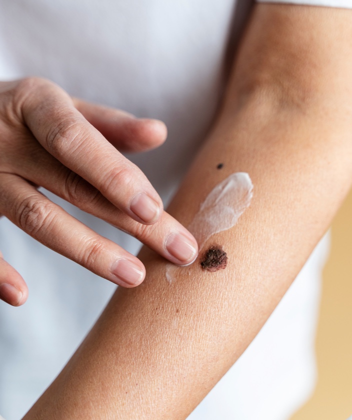 Cirurgia dermatológica de sinais, cistos e câncer de pele